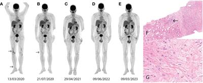 Case report: Targeted treatment strategies for Erdheim-Chester disease